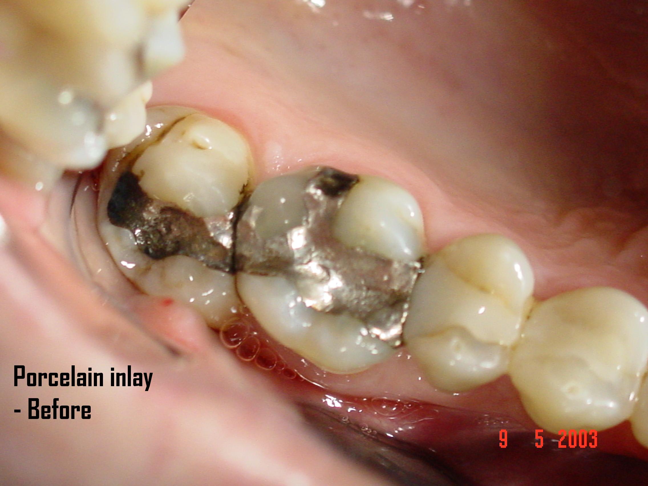 Porcelain inlay — before treatment